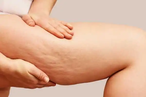 Image of woman showing leg with cellulite Hockley
