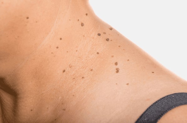 Are you looking for easy skin tag removal Hockley - then contact Spire today!