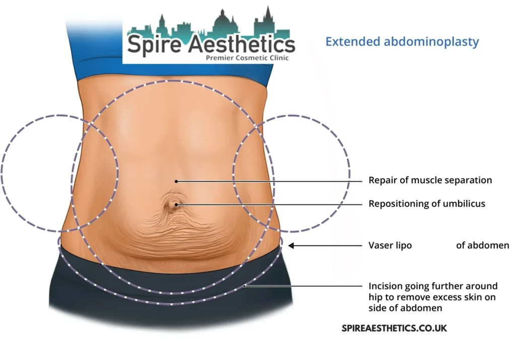 Understanding Loose Skin After Gastric Band Hockley Surgery and HIFU Treatment