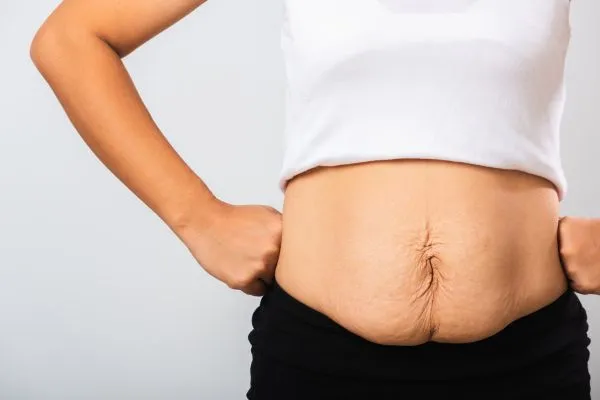 Image of a woman's stomach after weight loss with sagging skin following a gastric band Hockley