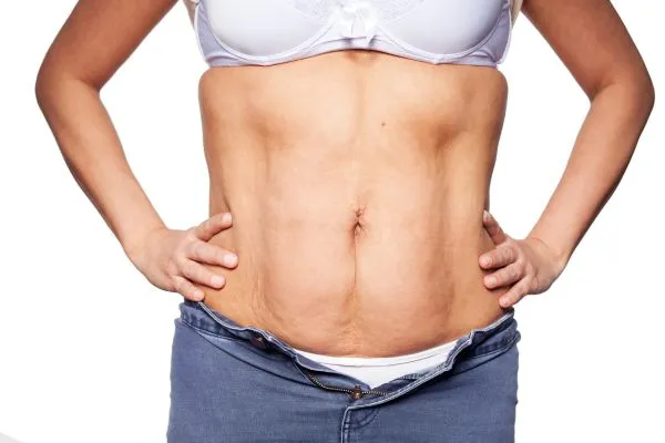 sagging skin on woman's stomach after weight loss injections Hockley