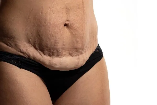 Image of womans stomach after weight loss injections Hockley showing saggy skin